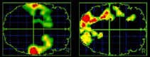 Hersenactiviteit onder hypnose (boven), en zonder hypnose (onder).chu <br><br><!--para1--><br><br><!--para2-->