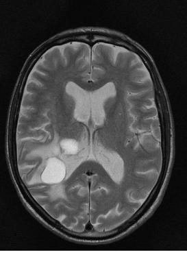 De (geleende) scan met tumor van onze verslaggever.
