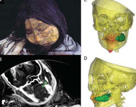 Mummie van een Incameisje, met in het groen op de scans resten van cocabladeren. 
