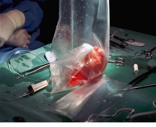 Een donornier klaar voor transplantatie.