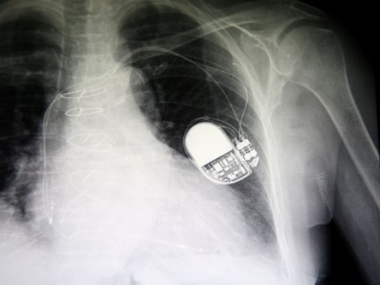 Duizenden pacemakers kwetsbaar voor hacking