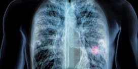 Preventieve CT-scan kan longkanker sneller ontdekken
