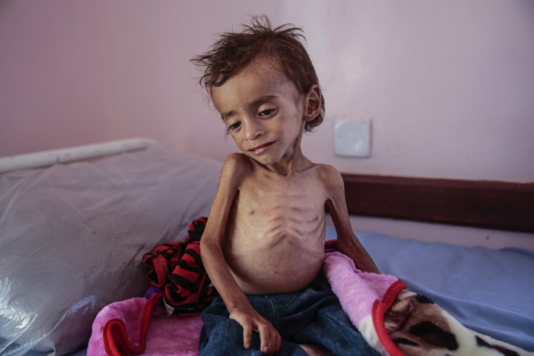 85.000 kinderen gestorven door honger in Jemen