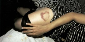 'Heart-shaped bruise, NYC' (1980)