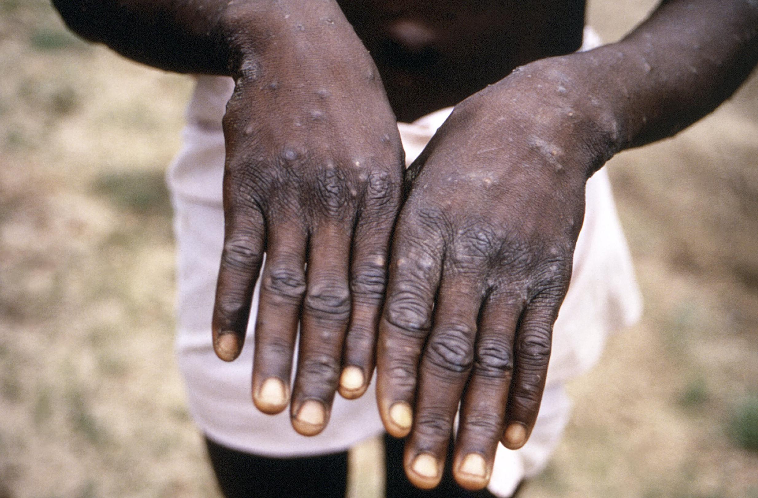 European monkeypox outbreak is unprecedented and worrying (but it won’t be another pandemic)