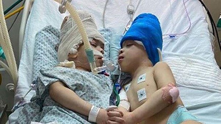 دوقلوهای به هم چسبیده با مغزهای به هم پیوسته با موفقیت از هم جدا شدند: 
