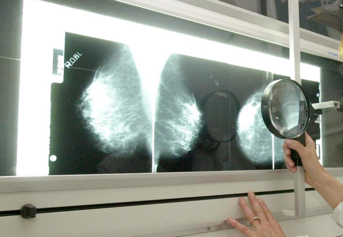 Lo screening del cancro al seno potrebbe non essere ampliato