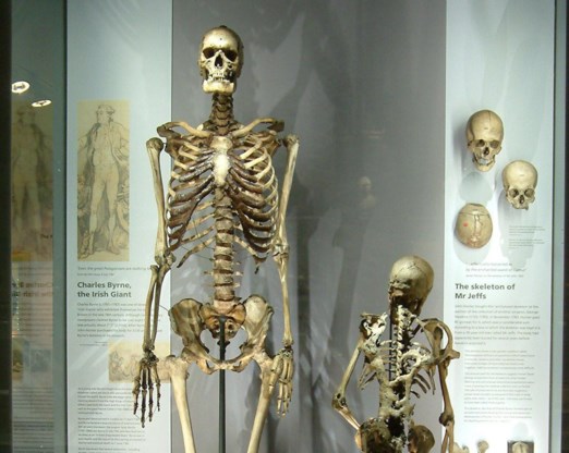 Londens museum verwijdert skelet van ‘Ierse reus’ wegens ‘ongepast’